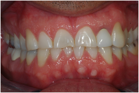 Full mouth dental rehabilitation Mumbai, india