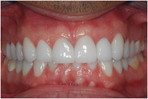 Full mouth rehabilitation dentist Mumbai, India