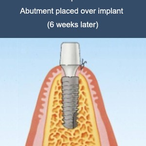 implant-work-3