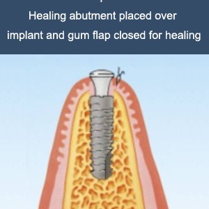 implant-work-2